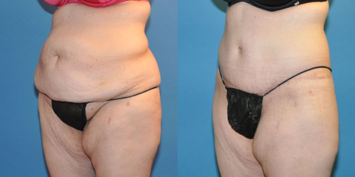 Lower Body Lift #20 - Before and After