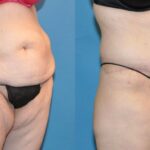 Lower Body Lift #20 - Before and After