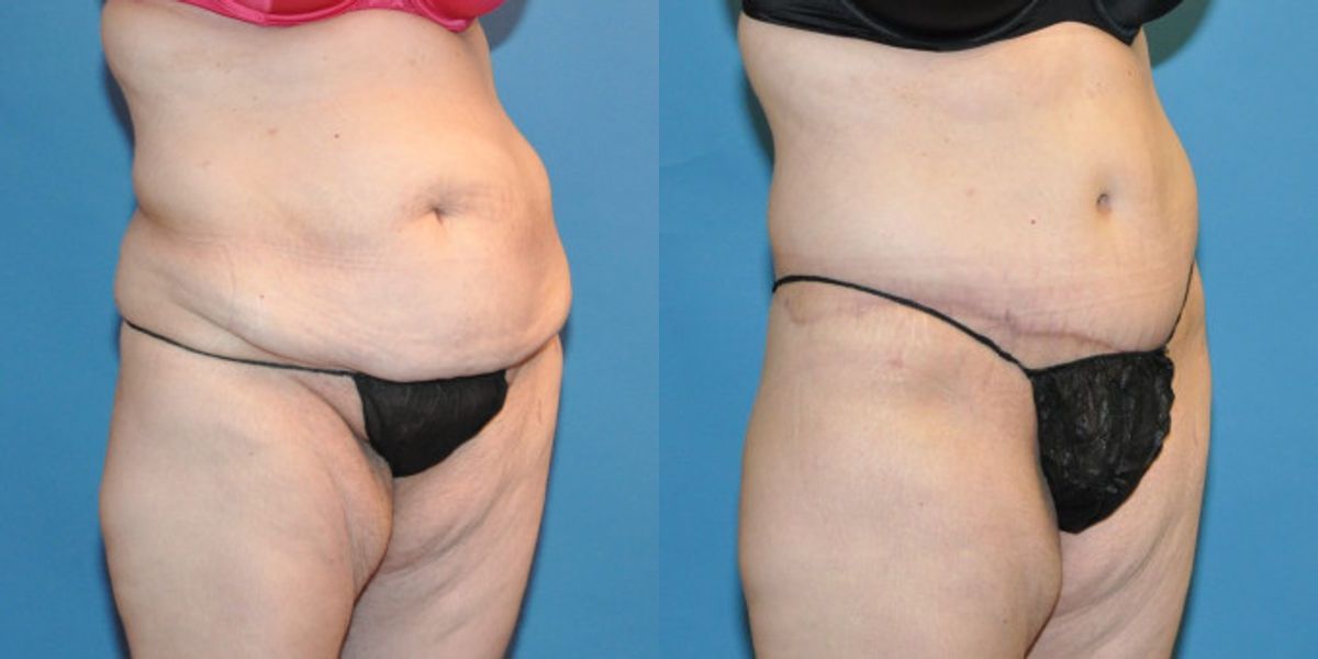 Lower Body Lift #20 - Before and After