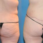 Lower Body Lift #20 - Before and After