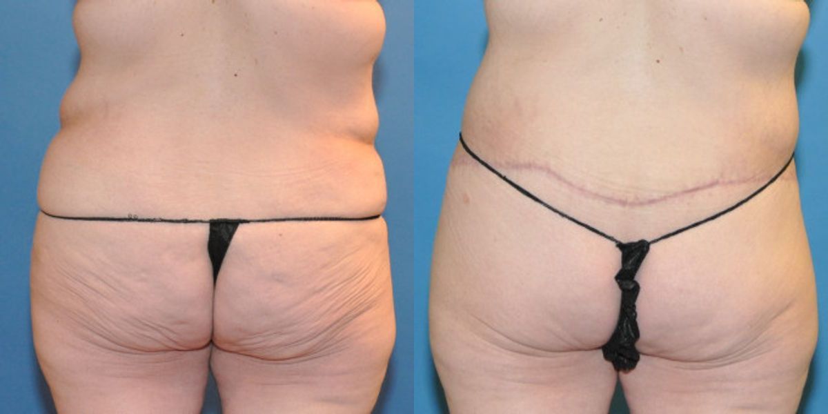 Lower Body Lift #20 - Before and After