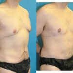 Lower Body Lift #21 - Before and After