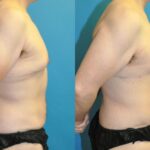 Lower Body Lift #21 - Before and After