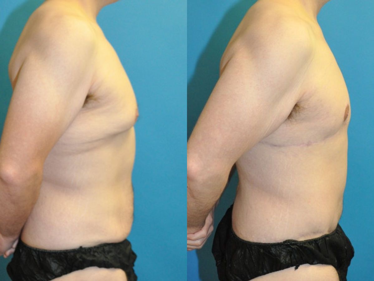 Lower Body Lift #21 - Before and After