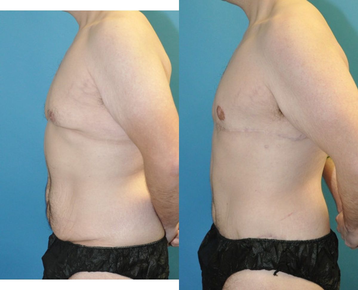 Lower Body Lift #21 - Before and After