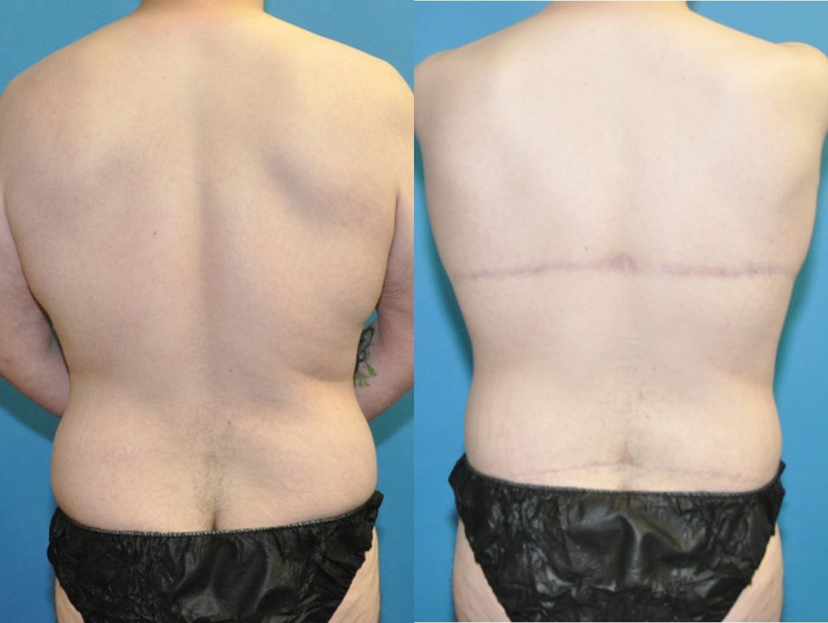 Lower Body Lift #21 - Before and After