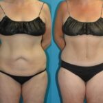 Lower Body Lift #22 - Before and After