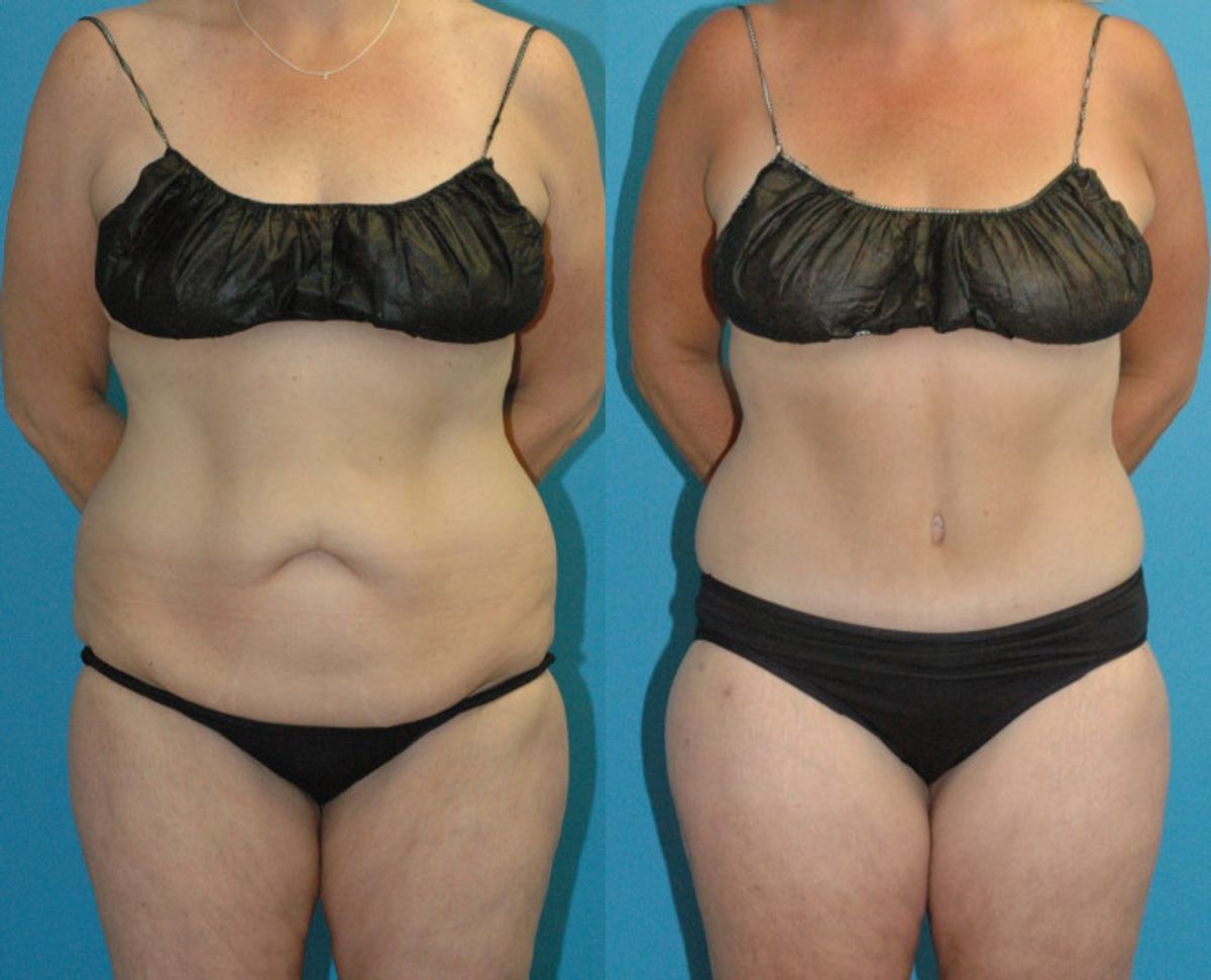 Lower Body Lift #22 - Before and After