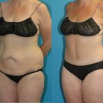 Lower Body Lift #22 - Before and After