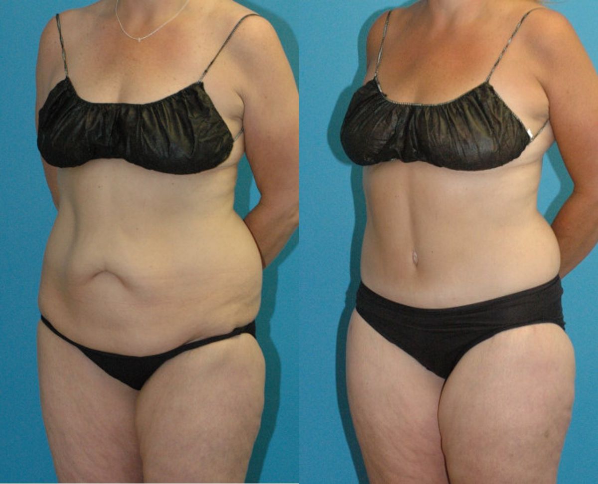 Lower Body Lift #22 - Before and After