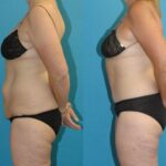 Lower Body Lift #22 - Before and After