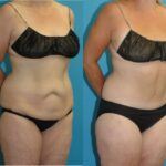 Lower Body Lift #22 - Before and After