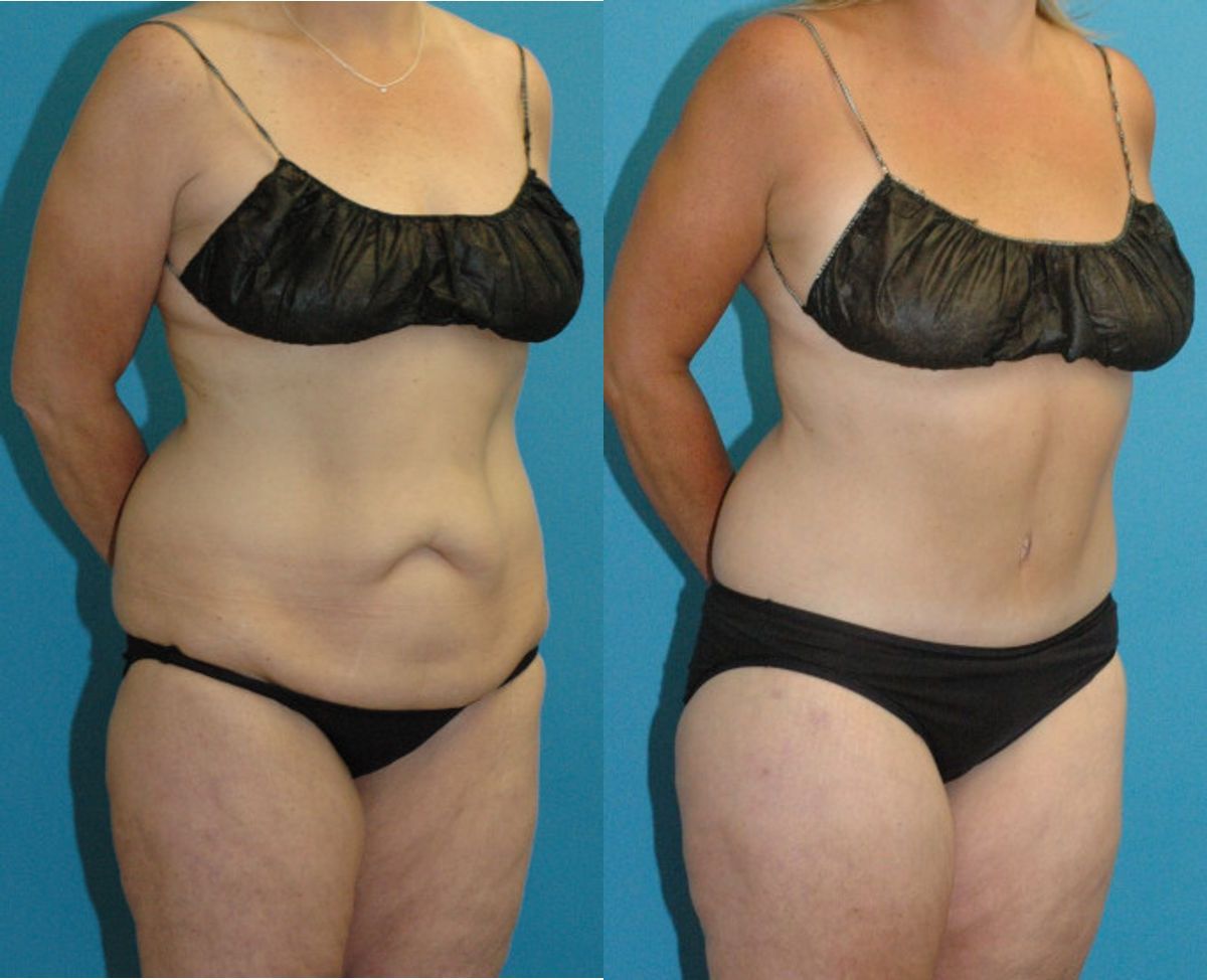 Lower Body Lift #22 - Before and After