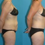 Lower Body Lift #22 - Before and After