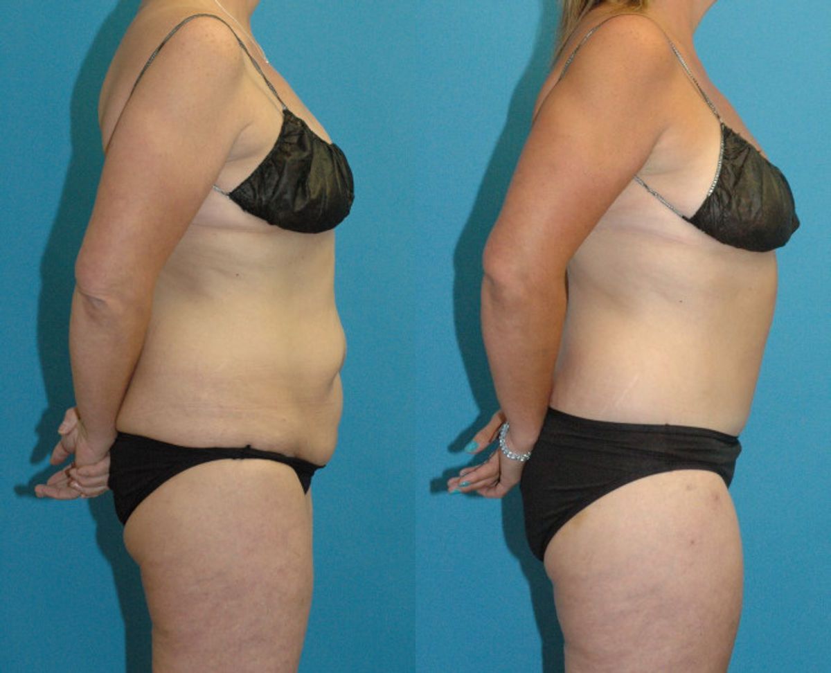 Lower Body Lift #22 - Before and After