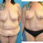 Lower Body Lift and Breast  Lift - Before and After