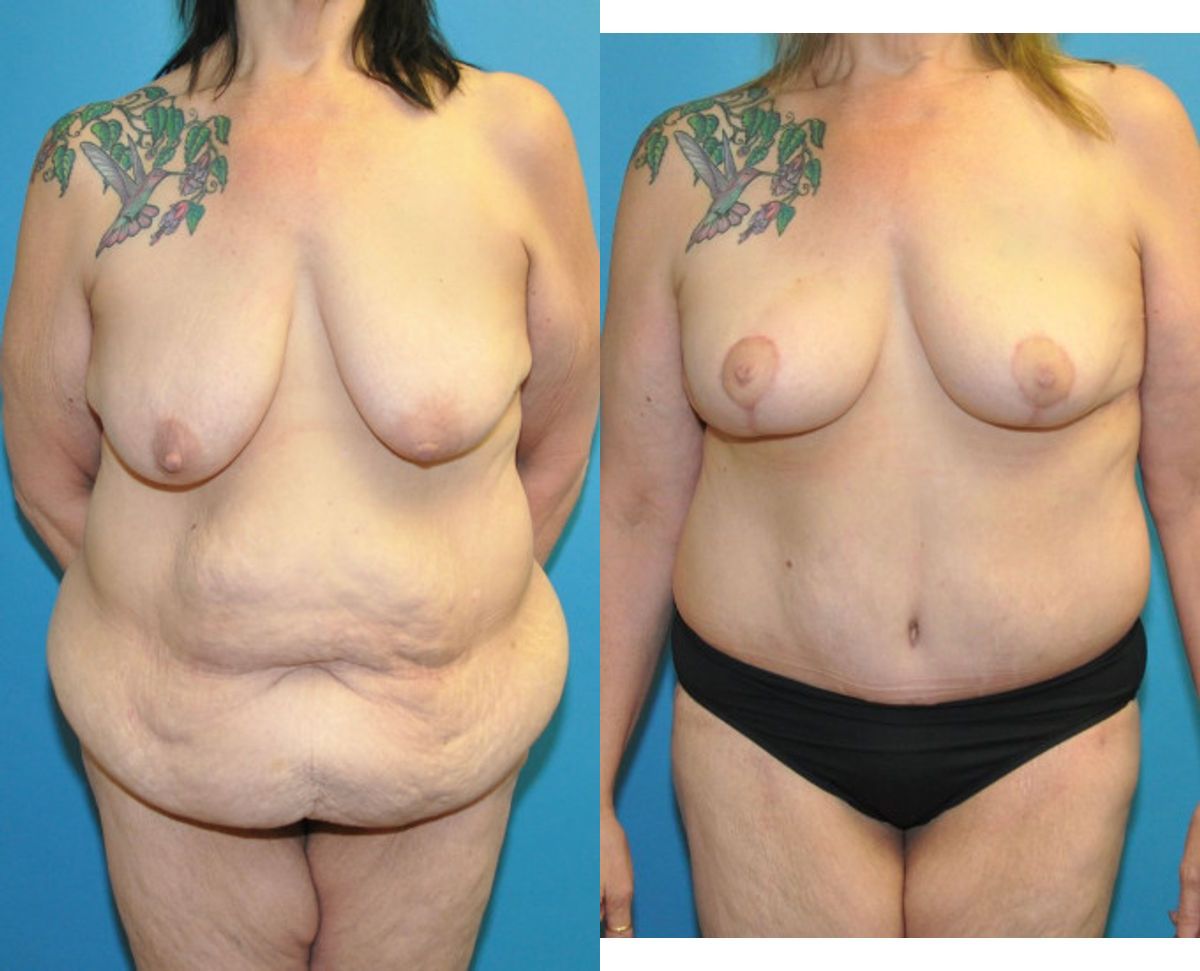 Lower Body Lift and Breast  Lift - Before and After