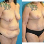 Lower Body Lift and Breast  Lift - Before and After