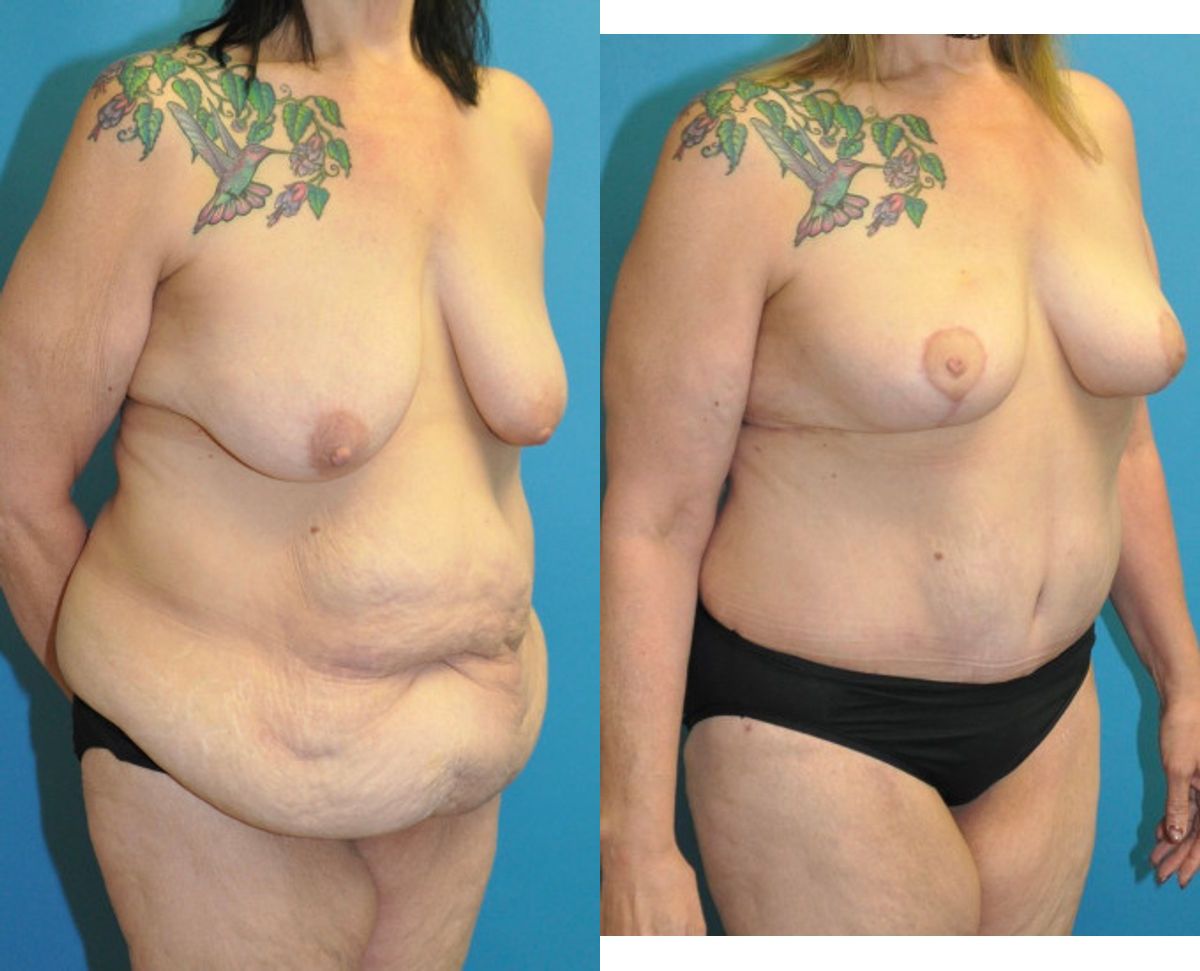 Lower Body Lift and Breast  Lift - Before and After