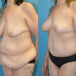 Lower Body Lift and Breast  Lift - Before and After