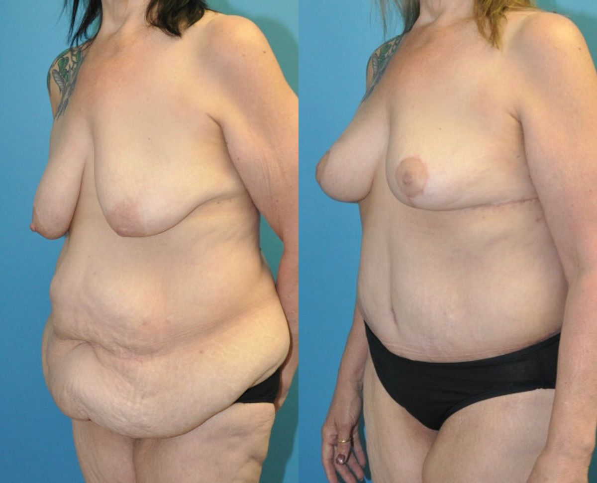 Lower Body Lift and Breast  Lift - Before and After