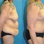Lower Body Lift and Breast  Lift - Before and After