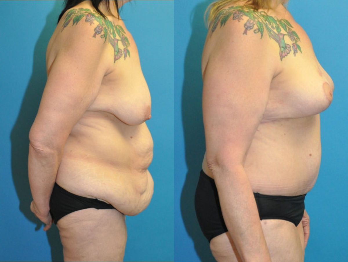 Lower Body Lift and Breast  Lift - Before and After
