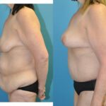 Lower Body Lift and Breast  Lift - Before and After