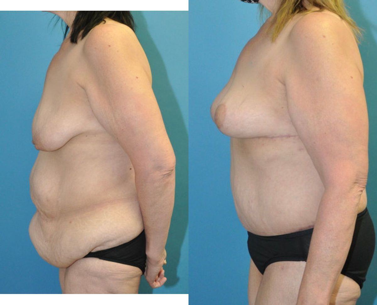 Lower Body Lift and Breast  Lift - Before and After