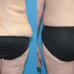 Lower Body Lift and Breast  Lift - Before and After