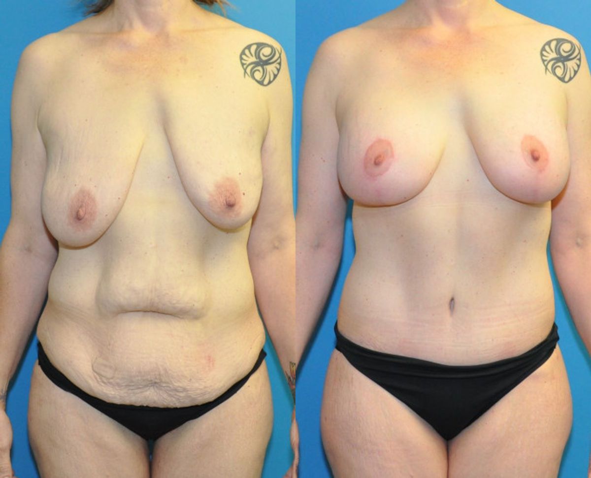 Lower Body Lift, Breast Augmentation and Lift, and Arm Lift - Before and After