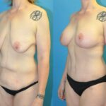 Lower Body Lift, Breast Augmentation and Lift, and Arm Lift - Before and After