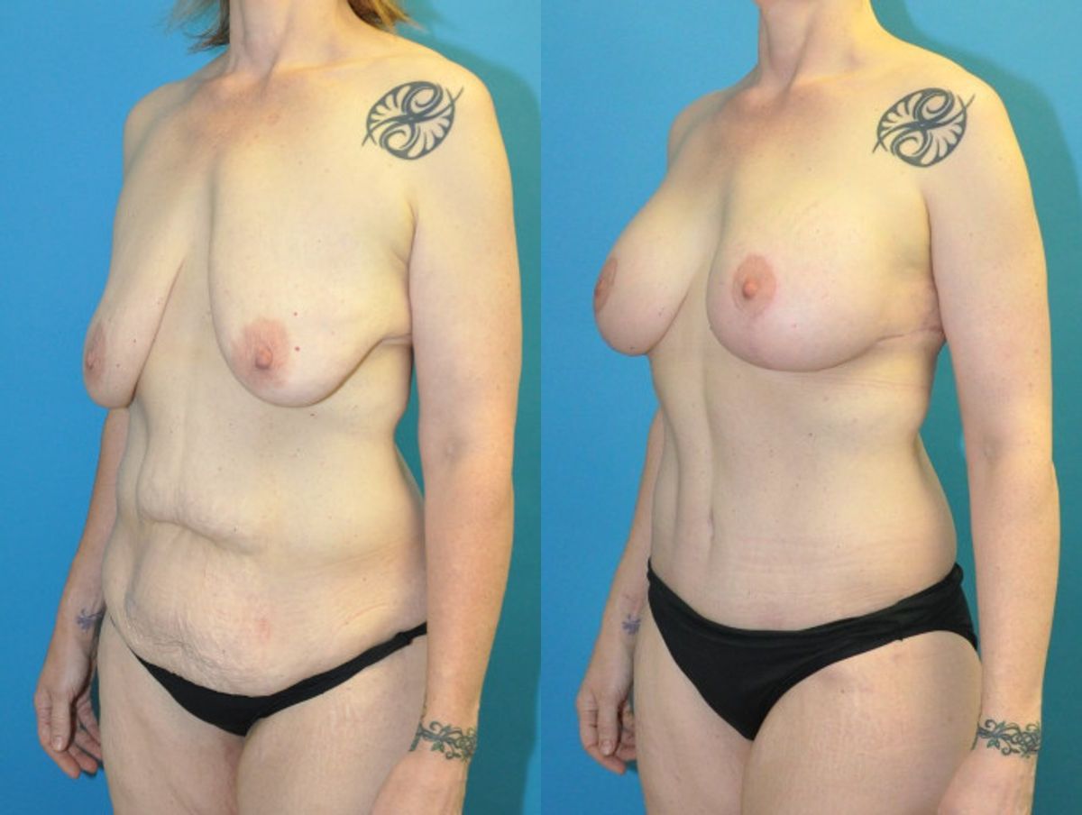 Lower Body Lift, Breast Augmentation and Lift, and Arm Lift - Before and After