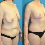 Lower Body Lift, Breast Augmentation and Lift, and Arm Lift - Before and After