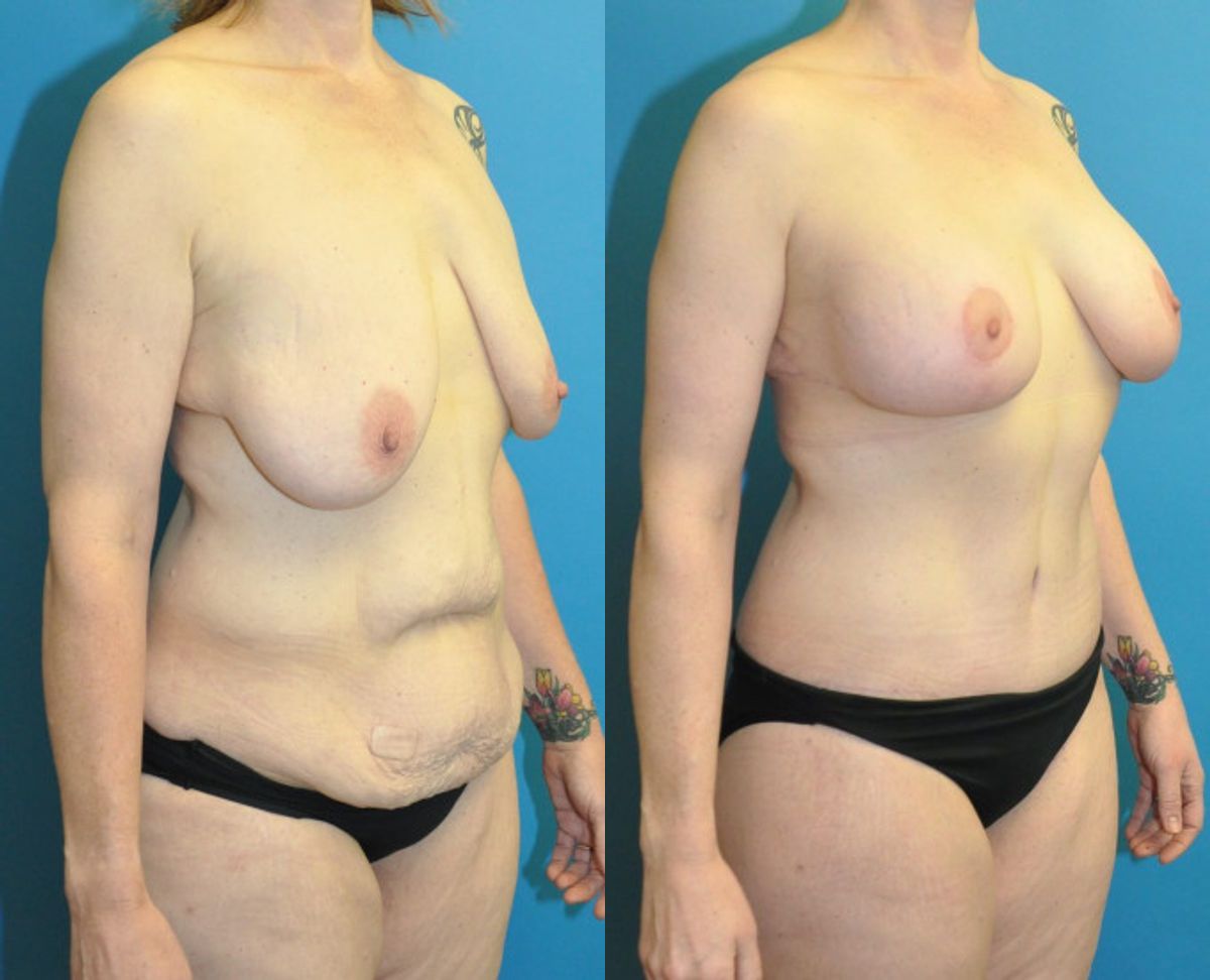 Lower Body Lift, Breast Augmentation and Lift, and Arm Lift - Before and After