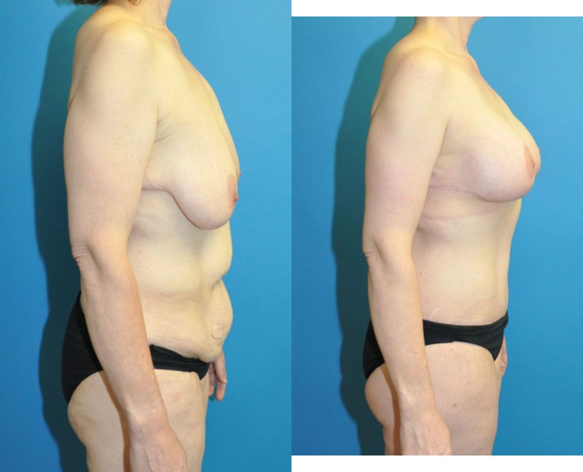 Lower Body Lift, Breast Augmentation and Lift, and Arm Lift - Before and After
