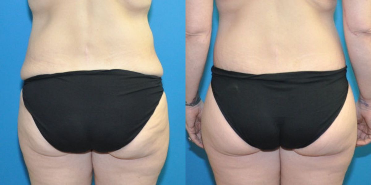 Lower Body Lift, Breast Augmentation and Lift, and Arm Lift - Before and After