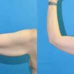 Lower Body Lift, Breast Augmentation and Lift, and Arm Lift - Before and After