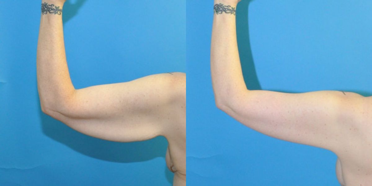 Lower Body Lift, Breast Augmentation and Lift, and Arm Lift - Before and After