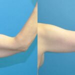 Lower Body Lift, Breast Augmentation and Lift, and Arm Lift - Before and After