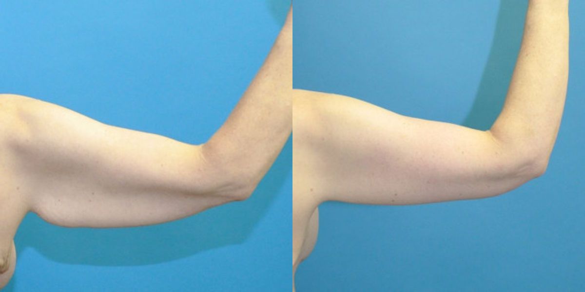 Lower Body Lift, Breast Augmentation and Lift, and Arm Lift - Before and After