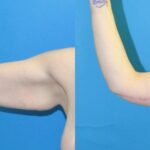 Lower Body Lift, Breast Augmentation and Lift, and Arm Lift - Before and After