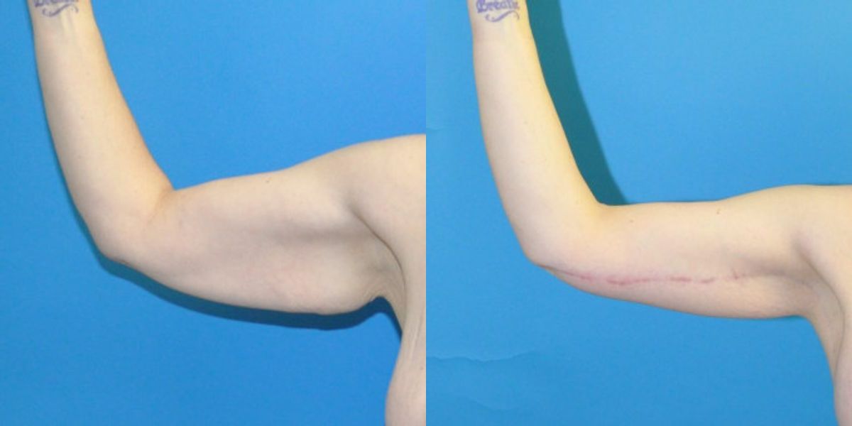 Lower Body Lift, Breast Augmentation and Lift, and Arm Lift - Before and After