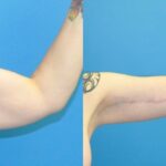 Lower Body Lift, Breast Augmentation and Lift, and Arm Lift - Before and After
