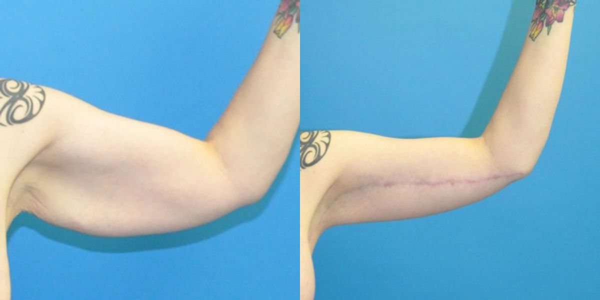 Lower Body Lift, Breast Augmentation and Lift, and Arm Lift - Before and After