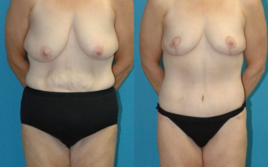 Lower Body Lift, Breast Reduction and Lift and Bra Roll Lift