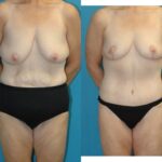 Lower Body Lift, Breast Reduction and Lift and Bra Roll Lift - Before and After