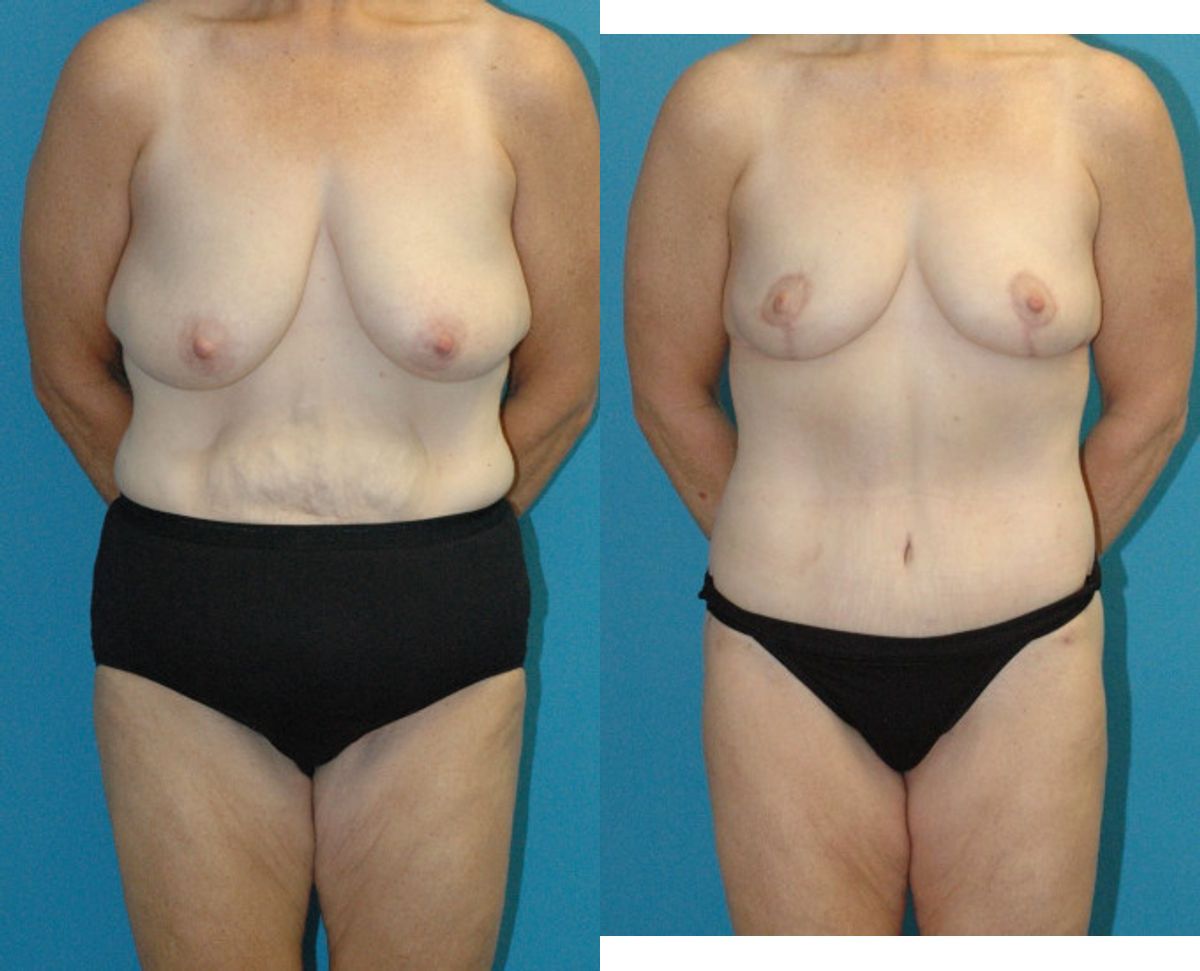 Lower Body Lift, Breast Reduction and Lift and Bra Roll Lift - Before and After