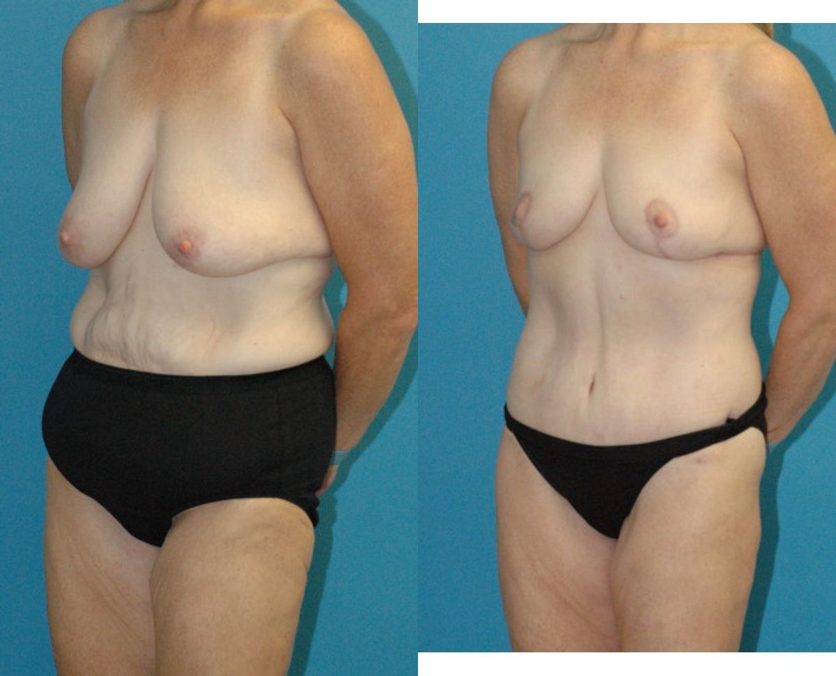 Lower Body Lift, Breast Reduction and Lift and Bra Roll Lift - Before and After