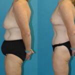 Lower Body Lift, Breast Reduction and Lift and Bra Roll Lift - Before and After